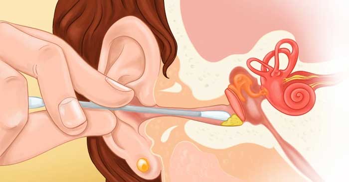 The harmful effects of cleaning ears with cotton swabs