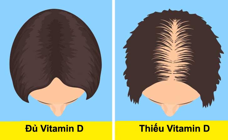 Rụng tóc là dấu hiệu thiếu vitamin D