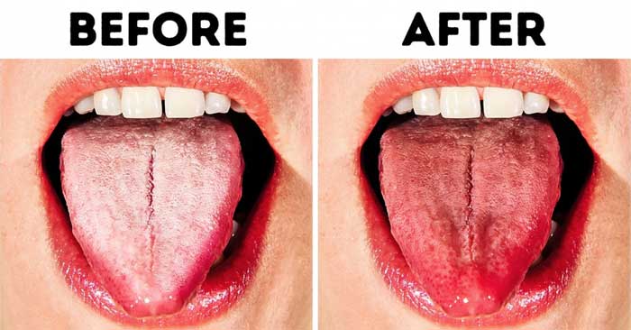 Cách làm sạch lưỡi trắng