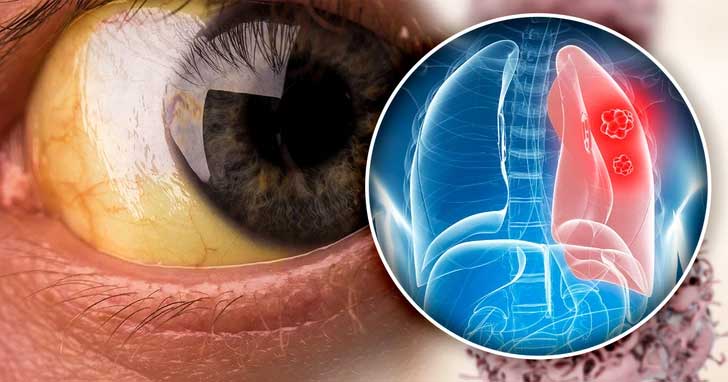 Mắt vàng cũng là dấu hiệu của bệnh phổi