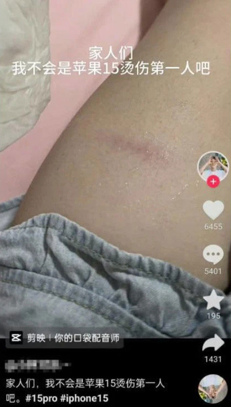 Bị bỏng ở đùi