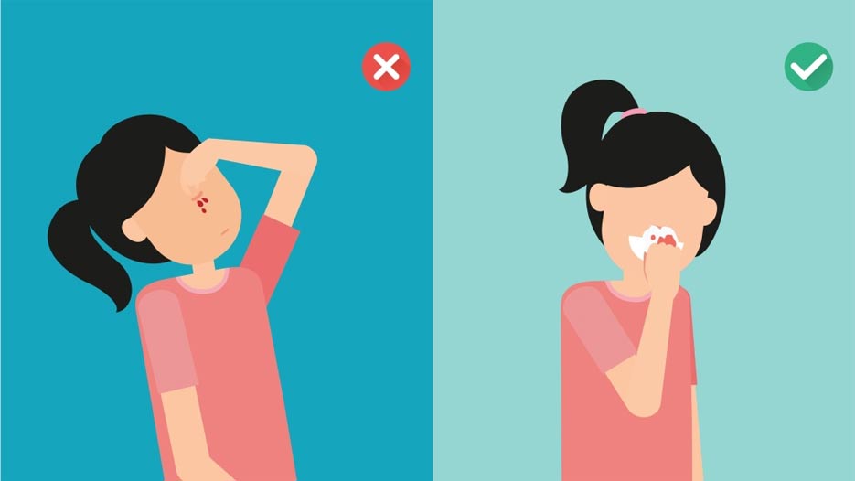 Cách chặn chảy máu cam