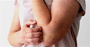 Cách kiểm soát tình trạng viêm mãn tính ở bệnh vẩy nến