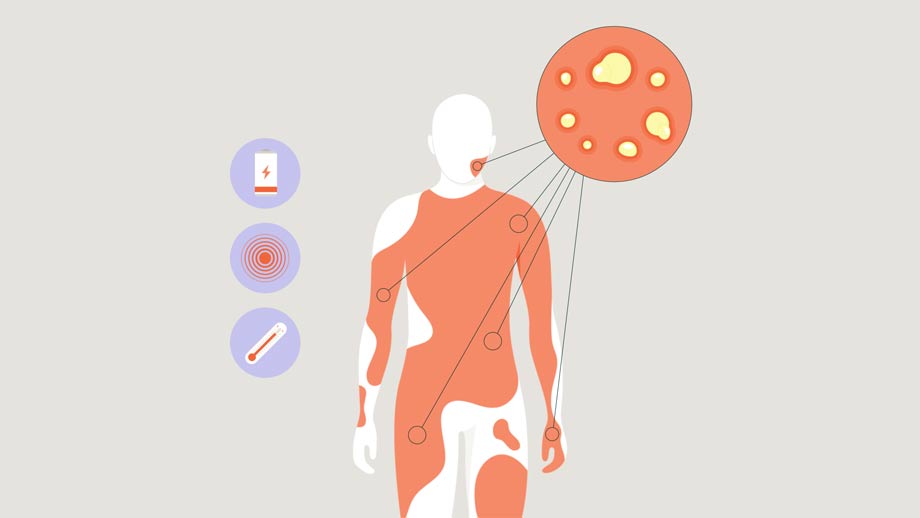 Nguyên nhân gây bệnh vẩy nến