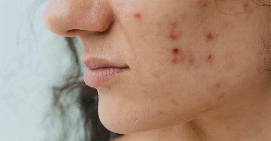 Dấu hiệu Cortisol cao