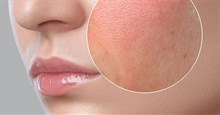 Sự khác biệt giữa da khô và da mất nước