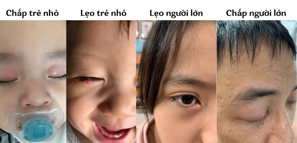 Bệnh chắp lẹo mắt
