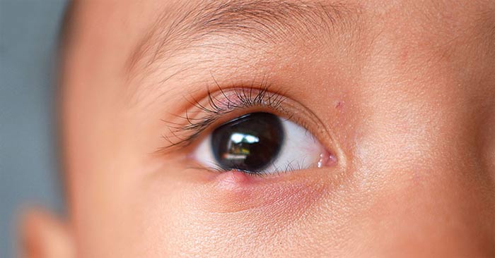 Lẹo và chắp mắt