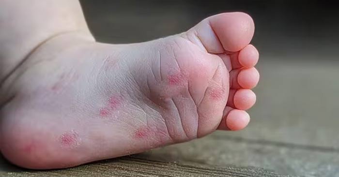 Tay chân miệng ở trẻ em