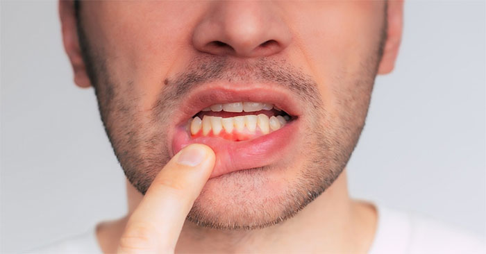 Thay đổi nhỏ trong chế độ ăn có thể giúp bảo vệ nướu răng