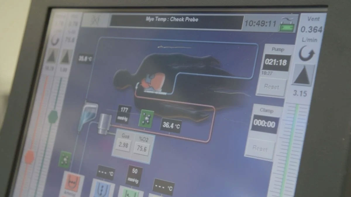 Màn hình theo dõi hiển thị lưu lượng máu, nồng độ oxy và nhiệt độ trong khi hệ thống phổi nhân tạo tạm thời thay thế chức năng phổi sau khi các bác sĩ phẫu thuật đã cắt bỏ phổi của bệnh nhân.